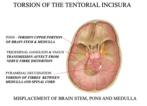 CFD Torsion of Tentorial Incisura 1